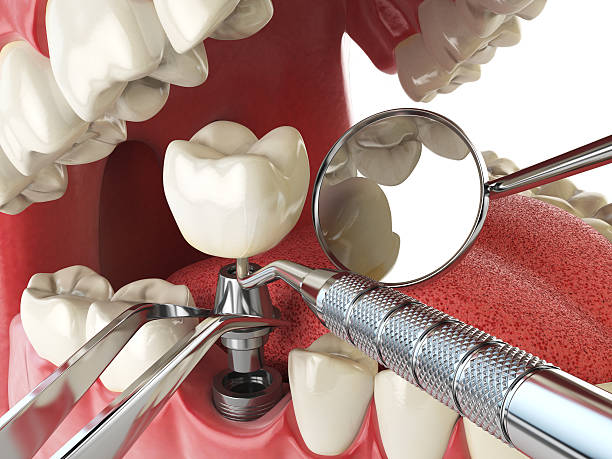 Tooth Infection Emergency Dentist in TX